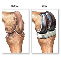 Knee Replacement